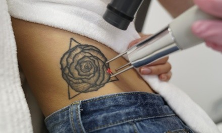 Three Laser Tattoo Removal Sessions at LaserAway(Up to 87% Off). Three Options Available.